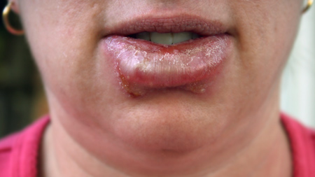 giant cold sore