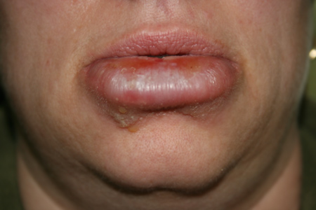 Pimple Below Lip