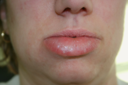 Cold Sore Images